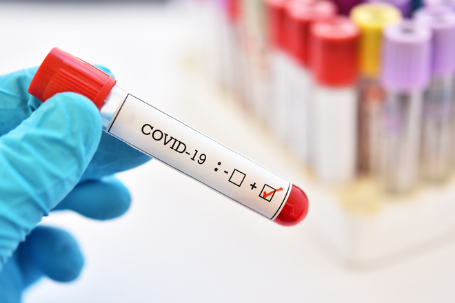 Prevalenza della Sierologia SARS-Cov-2 nei donatori di sangue nella Azienda Usl Umbria 2 durante la fase 3 dell’epidemia Covid-19 – Studio Osservazionale Prospettico